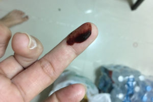 Угроза выкидыша 3 неделе беременности