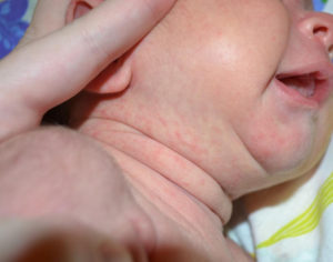 Потница у новорожденного как выглядит