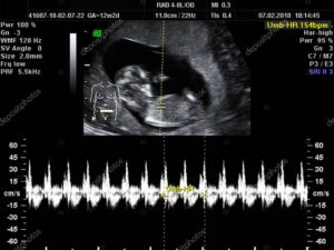 Тахикардия 12 неделе беременности