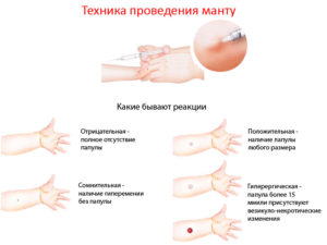 Прививка манта для чего