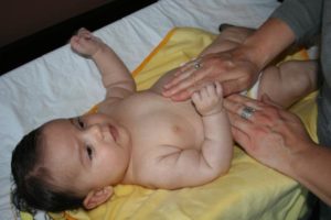 Как вылечить у новорожденного пупочную грыжу?