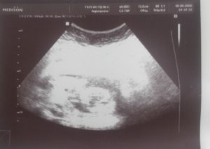 Гипертонус 14 неделе беременности