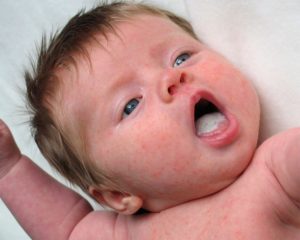 Как молочница проявляется у новорожденных?