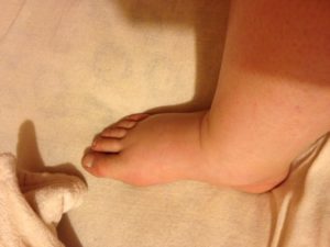 Отеки ног 25 неделя беременности