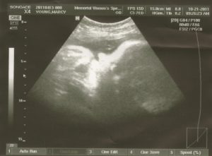 Роды 36 недель беременности повторнородящих