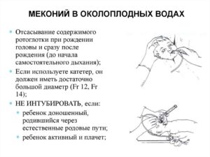 Мекония в околоплодных водах это переношенная беременность