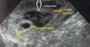 Беременность 7 недель гематома в матке