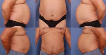 Как убрать висячий живот у мужчин? Как убрать висячий живот у мужчин?