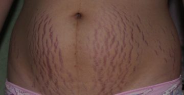 Как убрать растяжки после беременности на животе?