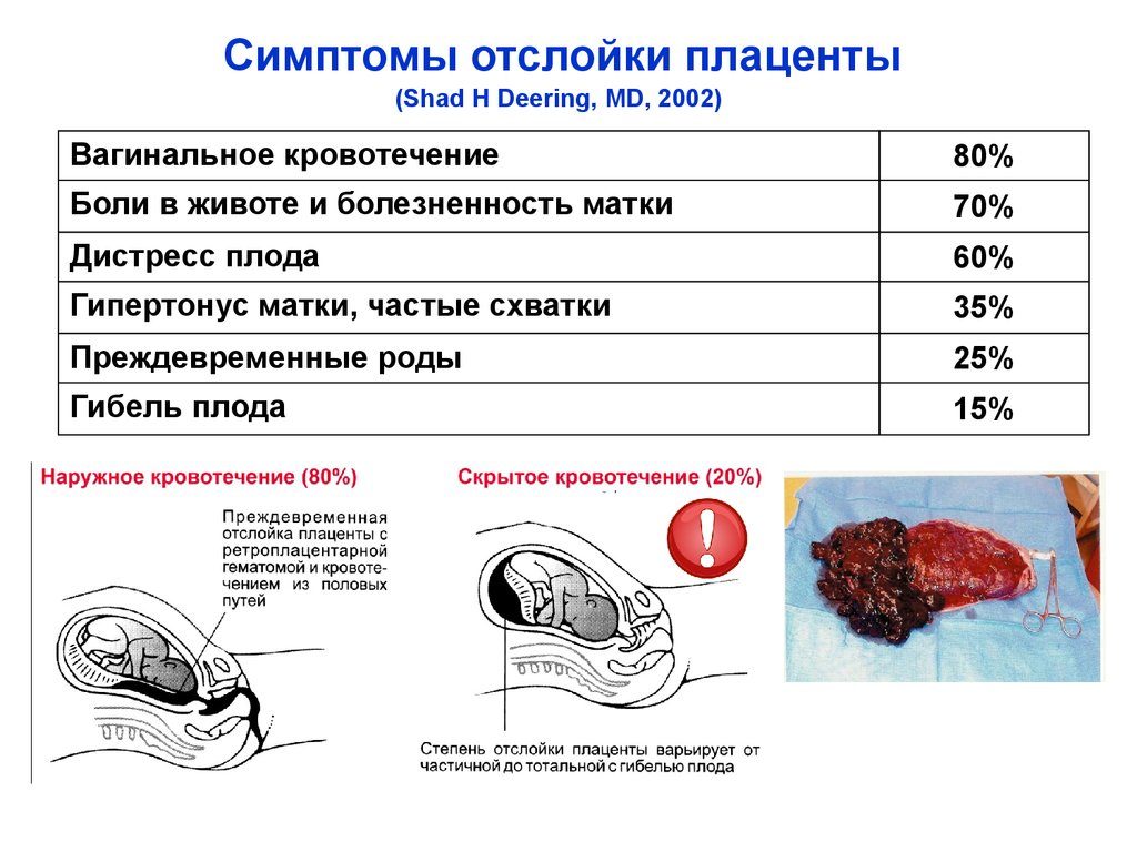 Отслойка плаценты на 40 неделе беременности