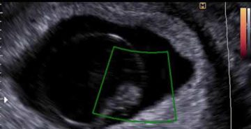 Узи замершая беременность 8 недель