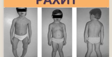 Рахит как выявить