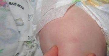 Можно ли купать после прививки акдс комаровский? Можно ли купать после прививки акдс комаровский?