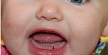 Первый зубик во сколько месяцев появляется Первый зубик во сколько месяцев появляется