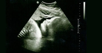 Узи на 32 34 неделе беременности