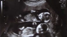 Двойняшки 21 неделя беременности