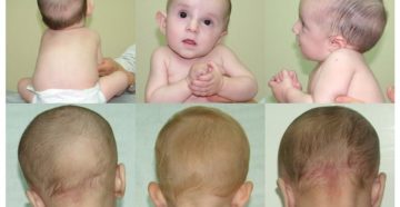 Кривошея у новорожденного что делать Кривошея у новорожденного что делать