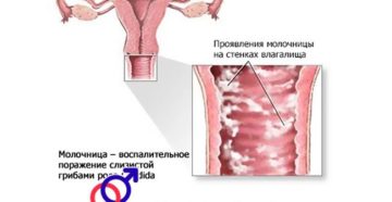 Молочница на 35 неделе беременности чем лечить