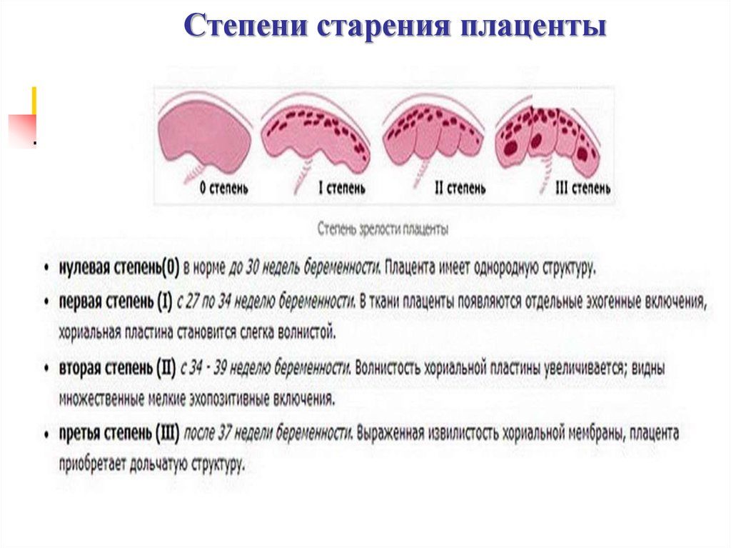 Преждевременное старение плаценты на 33 неделе беременности