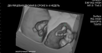 Беременность двойней 8 9 недель