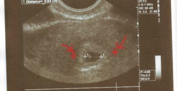 Эндометрий 4 неделе беременности