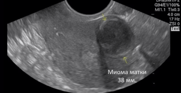 Симптомы миомы матки 8 9 недель