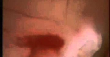 Кровотечение на 8 неделе беременности последствия