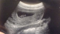 Тонус матки 7 недель беременности