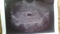 Эмбрион не визуализируется на 6 неделе