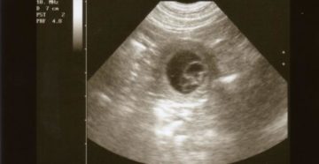 Акушерский срок беременности 4 недели Акушерский срок беременности 4 недели