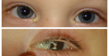 У ребенка 6 месяцев гноится глаз У ребенка 6 месяцев гноится глаз