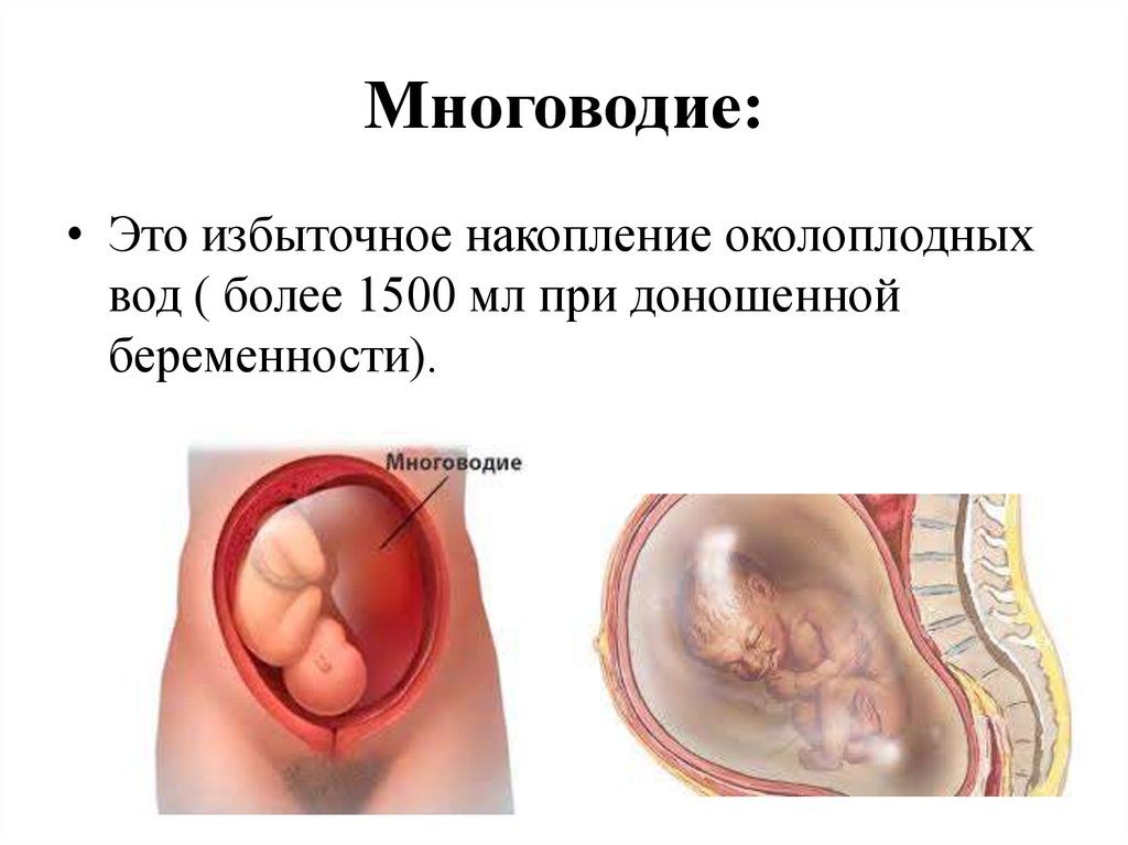 Многоводие на 39 неделе беременности