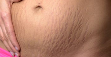 Как избавится от растяжек после беременности? Как избавится от растяжек после беременности?