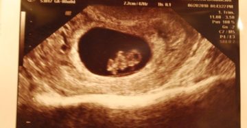 Боли на 8 неделе беременности