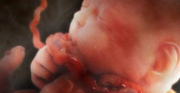 Обвитие пуповиной на 32 неделе беременности