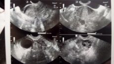 Боли яичниках 8 неделе беременности