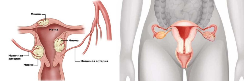 Миома матки 14 недель размеры