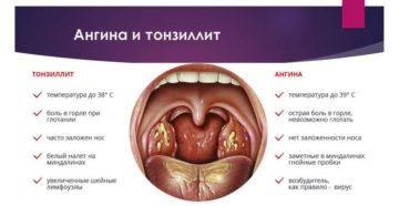 Болит горло на 14 неделе беременности