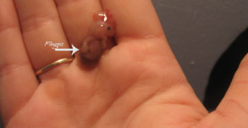 Выкидыш на второй неделе беременности