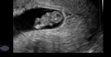 Срок беременности 8 9 недель