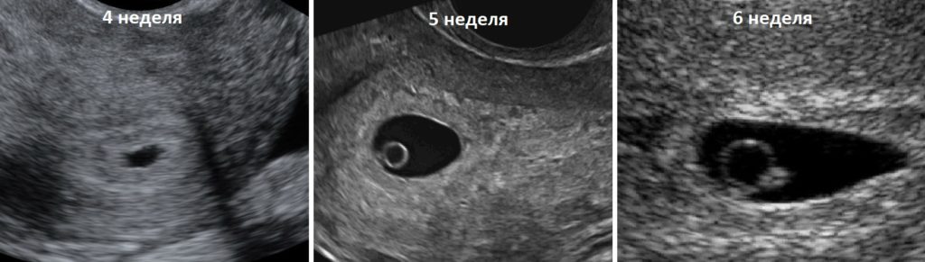 Узи 3 эмбриональной неделе