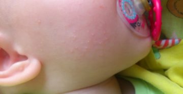 На щечках прыщики у ребенка На щечках прыщики у ребенка