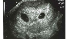 Беременность 5 недель двойня