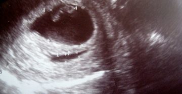 10 Неделя беременности отслойка оболочек хориона