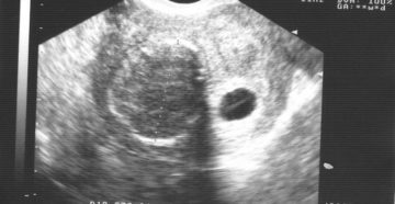 Беременность 6 недель миома матки