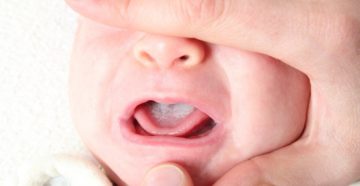 Налет на языке у новорожденного от молока Налет на языке у новорожденного от молока