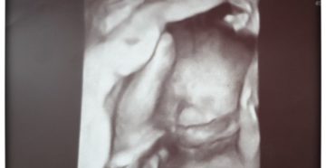 Очень активный ребенок 32 недели