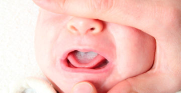 Лечить молочницу у новорожденного во рту Лечить молочницу у новорожденного во рту