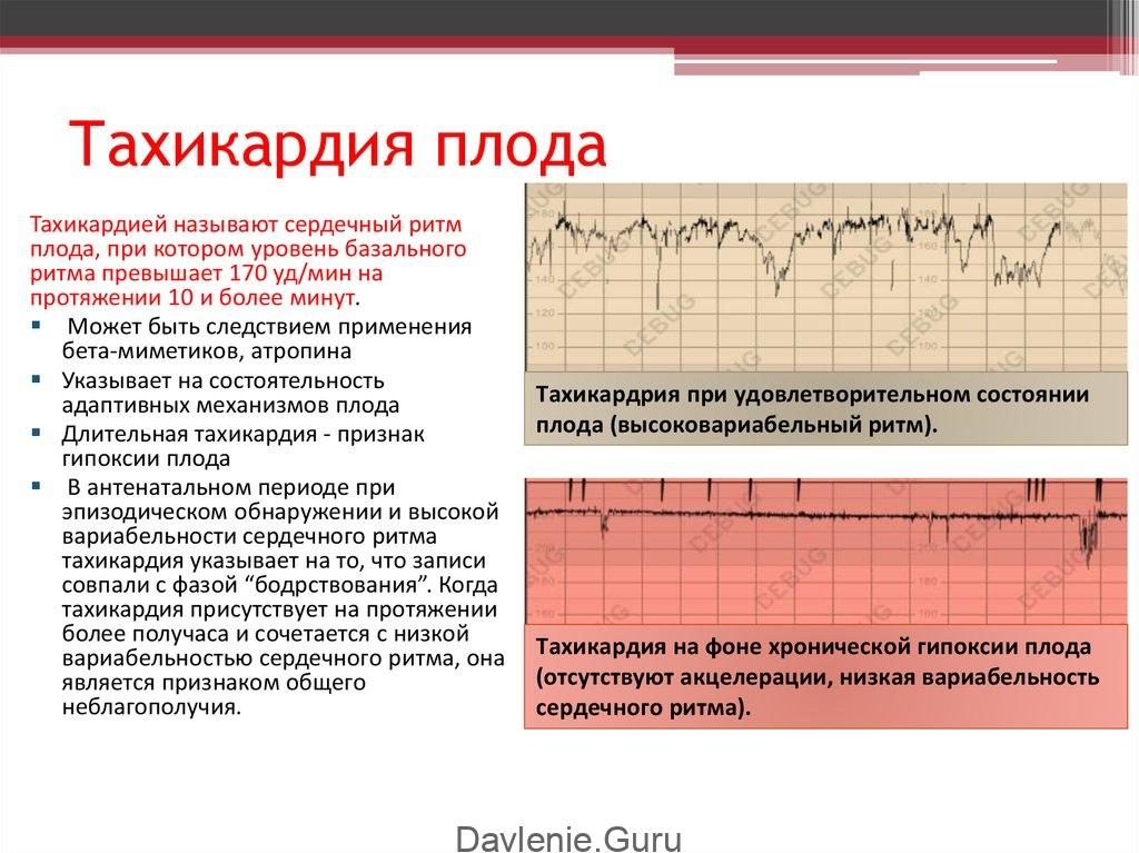 Тахикардия у плода 36 недель