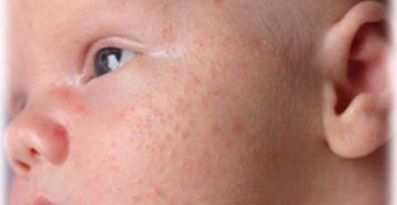 Красные пупырышки у новорожденного Красные пупырышки у новорожденного